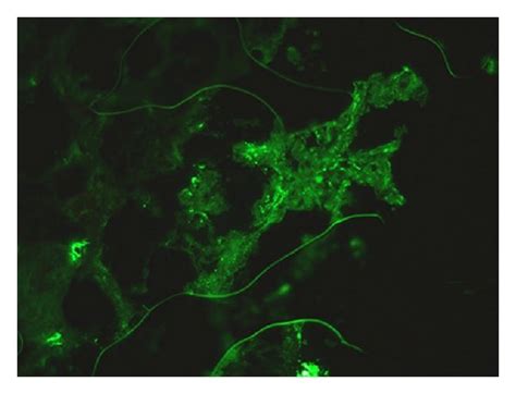 Direct Immunofluorescence Showing Granular Mesangial Staining For Iga