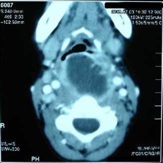 Laryngoscope View Demonstrating Bulging Of Posterior Pharyngeal Wall In