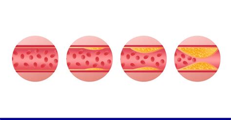 What Causes Calcium In Arteries? (Complete Guide)