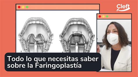 Todo lo que necesitas saber sobre la faringoplastía YouTube