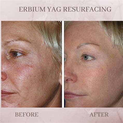 Erbium Skin Resurfacing Eluma Laser Aesthetics