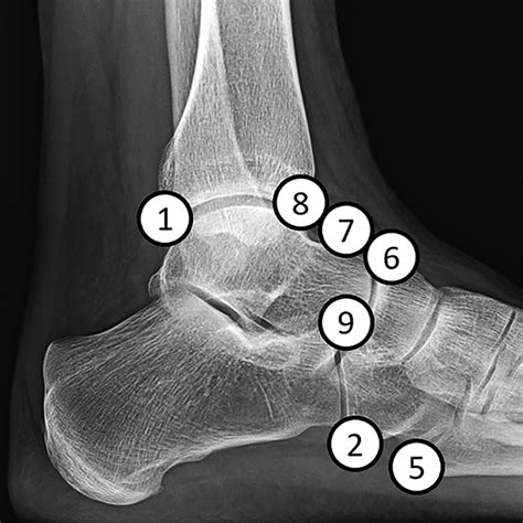 Accessory Ossicles Foot