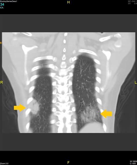 COVID-19 CT scan - wikidoc