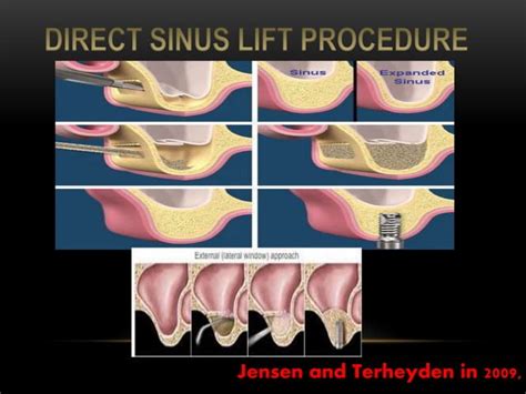 Maxillary sinus sinus | PPT