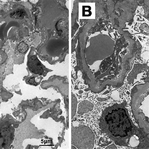 Figure2 Electron Microscopy Image Showing Granular Electron Dense