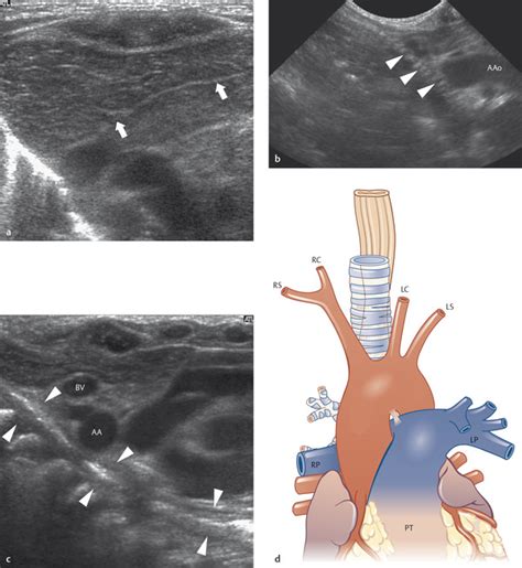 Tracheoesophageal Fistula Ultrasound