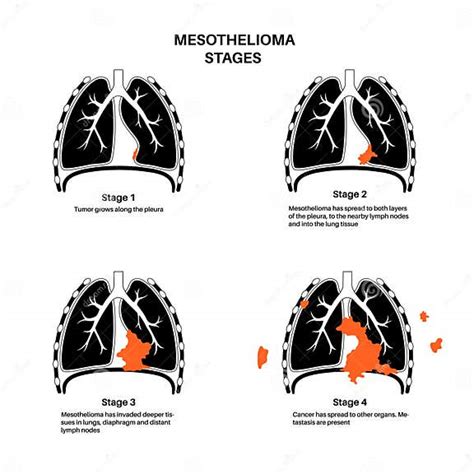 Mesothelioma Cancer Stages Stock Vector Illustration Of Construction