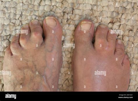 Cellulitis Toe