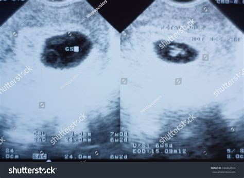 Ultrasound Human Fetus Stock Photo 144462814 | Shutterstock