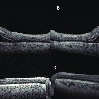 Swept Source Optical Coherence Tomography Of The Right Eye A And Left