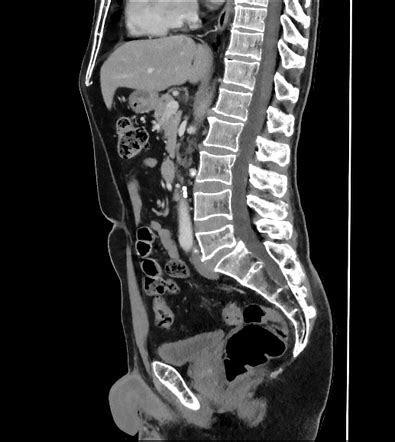 Focal Omental Infarction Image Radiopaedia Org