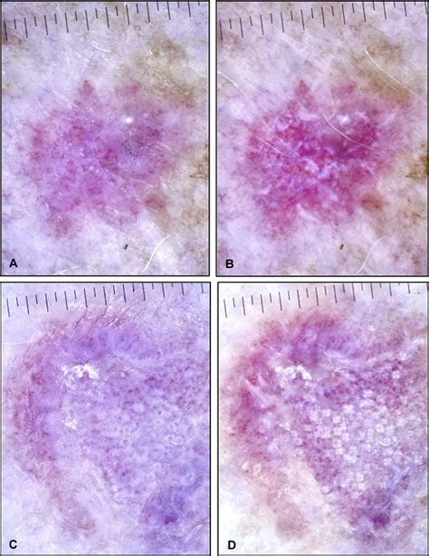 Polarized Light Dermoscopy To Aid In The Diagnosis Of New Pink Lesions