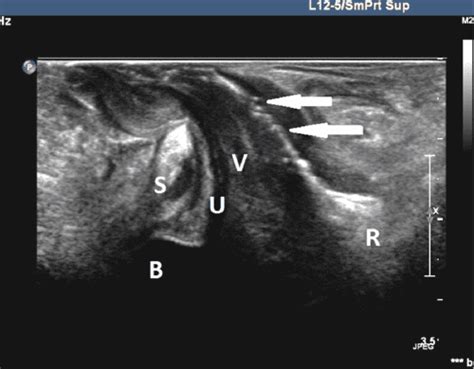 Figure From Usefulness Of Transperineal Ultrasonography Tpus In