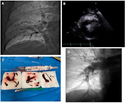 Pulmonary CT Angiogram Showing A Large Thrombus Burden In The Distal