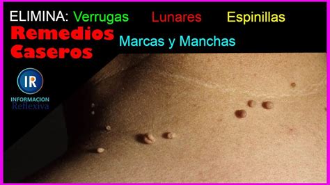 Elimina Todas Las Verrugas Lunares Fibromas Espinillas 89D