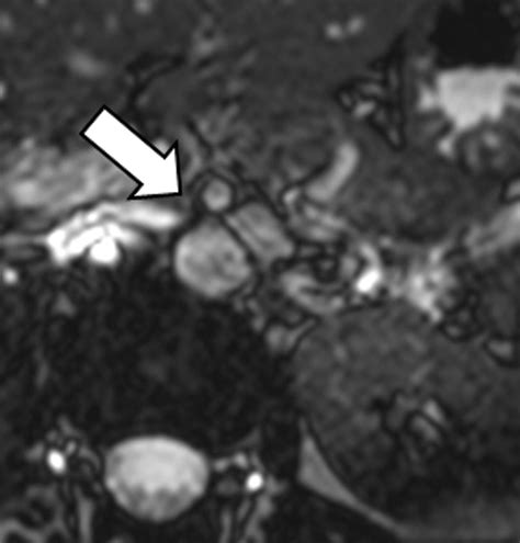 The Renal Vasculature What The Radiologist Needs To Know Radiographics