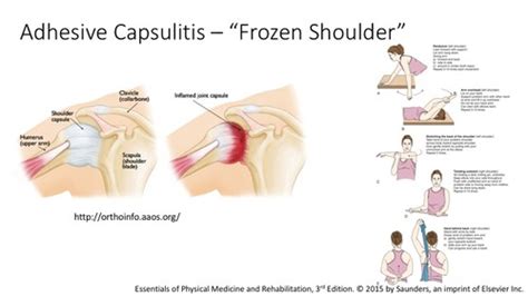 Frozen Shoulder Flashcards Quizlet