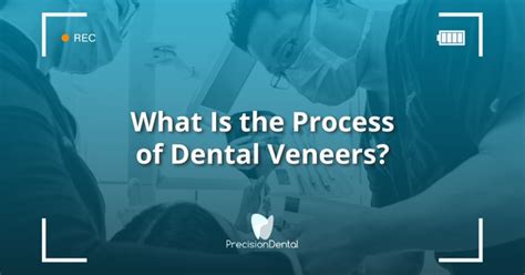 What Is the Process of Dental Veneers? - Precision Dental