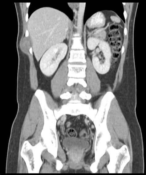 Multiple Schwannomas Image Radiopaedia Org