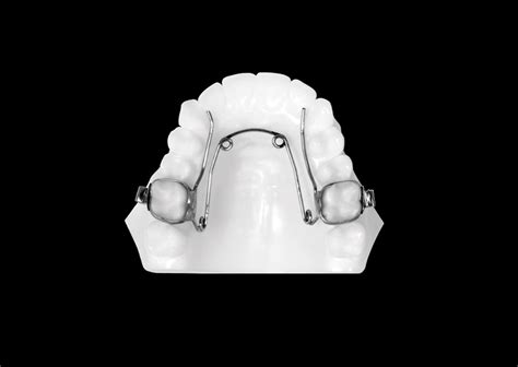 Quad Helix (Upper) - Universal Orthodontic Lab