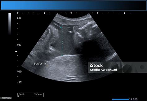 Identical Twin Boys Obstetrical Ultrasound Stock Photo - Download Image ...