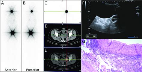 A B Panels Images Showed Intense Radioiodine Uptake In Thyroid Bed