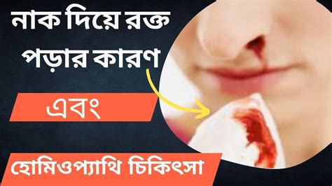 Nose Bleeding 🤧 নাক দিয়ে রক্ত কেন পড়ে হোমিওপ্যাথি সমাধান কি Youtube