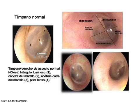 Otitis Media Supurada Y Serosa PPT Descarga Gratuita