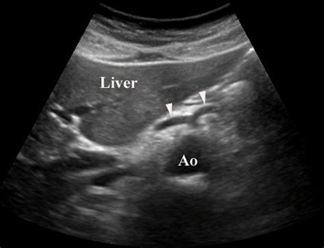 Biliary Images Emergency Ultrasonography