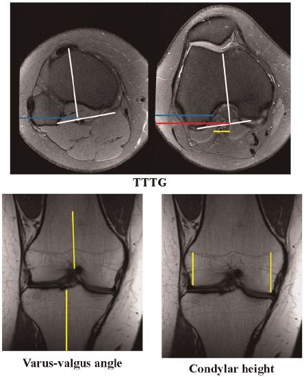 Trochlear Tubercle