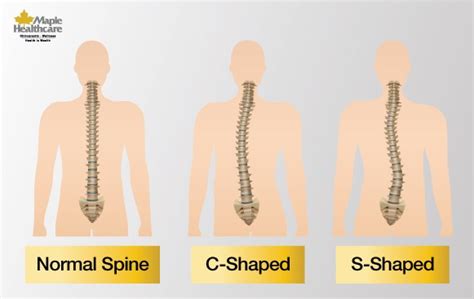 The Stages Of Scoliosis — And How To Treat It Maple Healthcare Vietnam