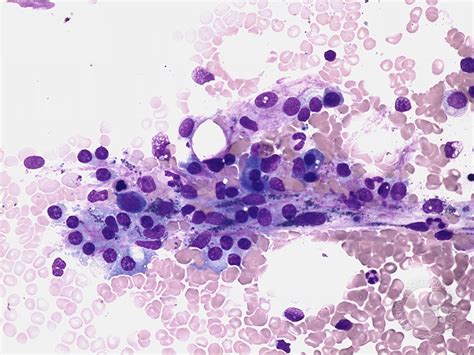 Plasma cells - 1.