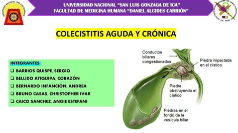 Colecistitis Aguda Y Cr Nica Mabel Pariona Chu Occa Udocz