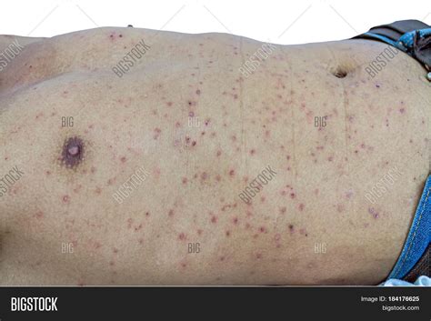 Close Man Papule Rash Image Photo Free Trial Bigstock