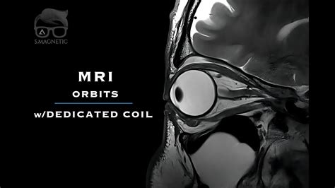 Mri Orbits Wdedicated Coil Youtube