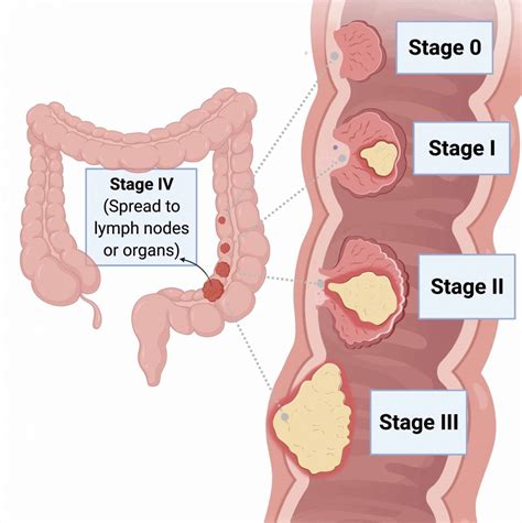 Stage IV cancer Treatment - Aastha Oncology Associates