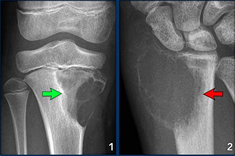 Osteoclastoma X Ray