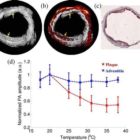 A IVUS And B Combined IVUS IVPA 1210 Nm Wavelength Images Of The