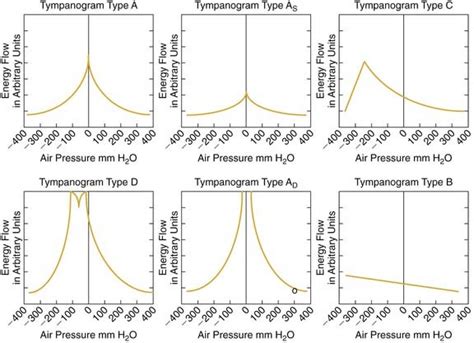 Sensorineural Hearing Loss Tympanogram