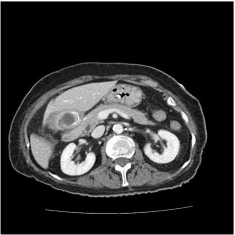 Ultrasoundguided Percutaneous Transhepatic Biliary Drainage Ptbd Was