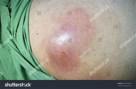 Abdominal Wall Abscess Stock Photo 760744684 Shutterstock