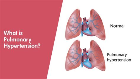 What Is Pulmonary Hypertension German Heart Centre