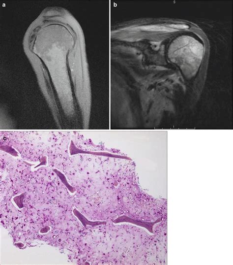 Bone Marrow Chemotherapy Springerlink