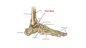 Life After Talonavicular Fusion | Centeno-Schultz Clinic