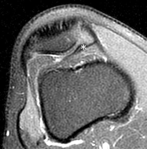 Magnetic Resonance Imaging Of A Duplicated Medial Plica Asterisk