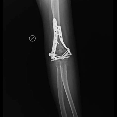 X-ray image showing callus formation at 6 weeks postoperative ...