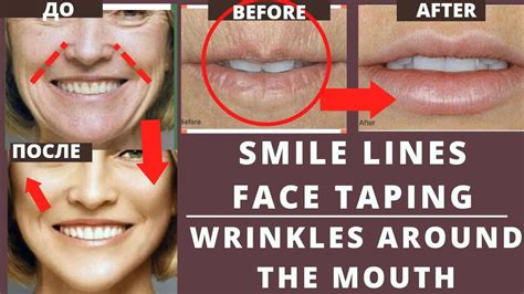 Remove Smile Lines Wrinkles Around The Mouth Face Taping Nasolabial