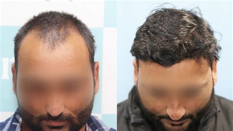 Best Hair Transplant Result 2021 Nw Grade Iii 2861 Grafts Regrow Clinic Haridwar Youtube