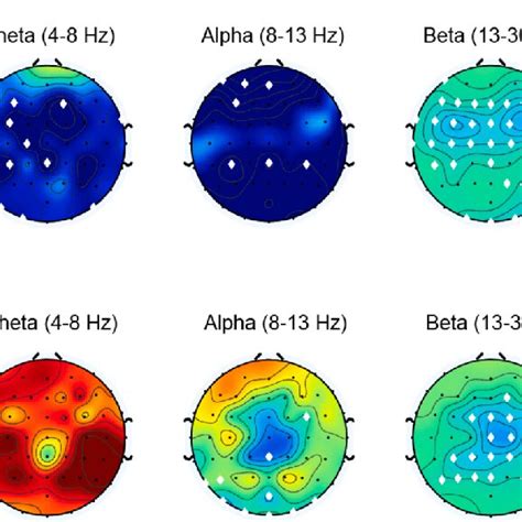 Scalp Topography Of Relative Eeg Power In Pd Patients With Depression