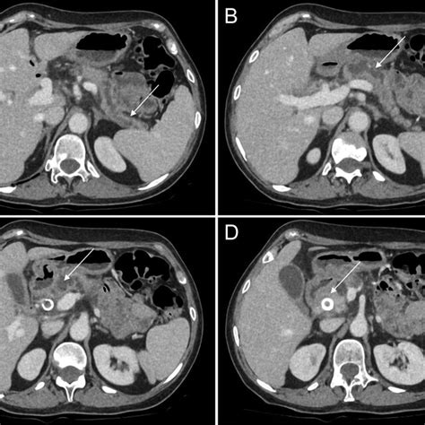 CT Abdomen Pelvis Scan Demonstrating Ampullary Tumour Adjacent To